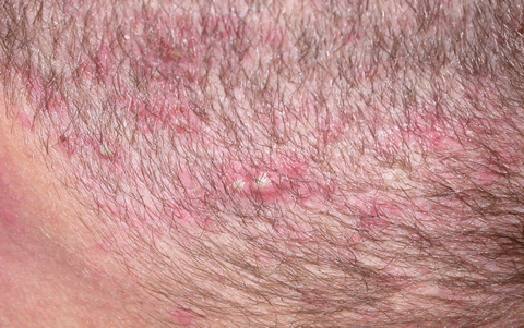 acne adult scalp acne adult scalp